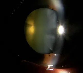 白内障手術 術前視力 0.4