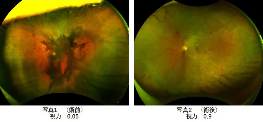 糖尿病網膜症 術前術後視力