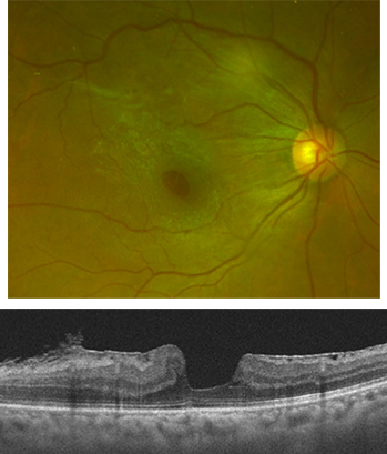 網膜前膜　術前　視力0.6