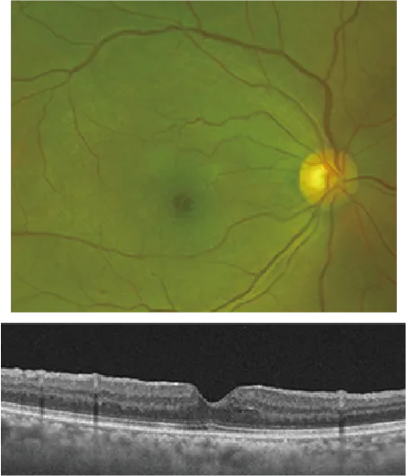 網膜前膜　術後　視力1.0