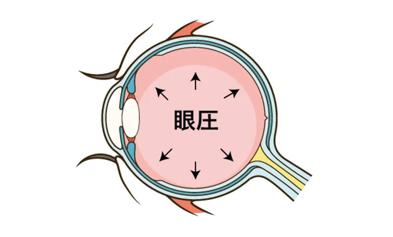 日帰り緑内障手術